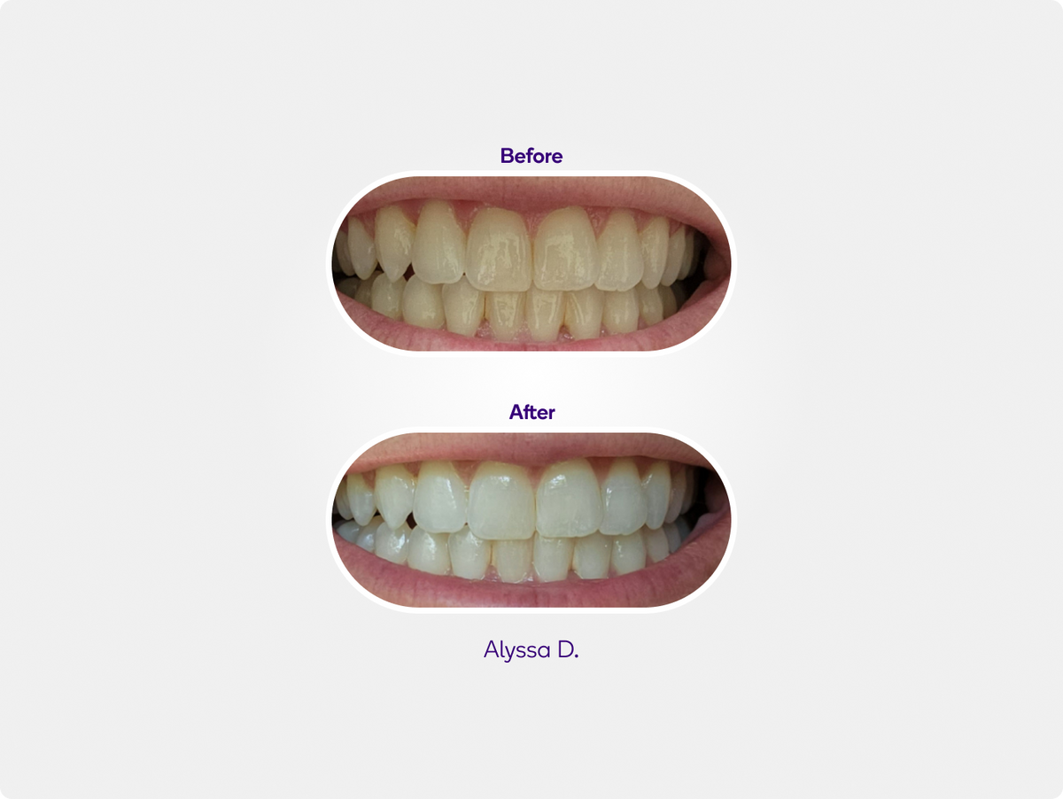 Color: Black; teeth whitening pen