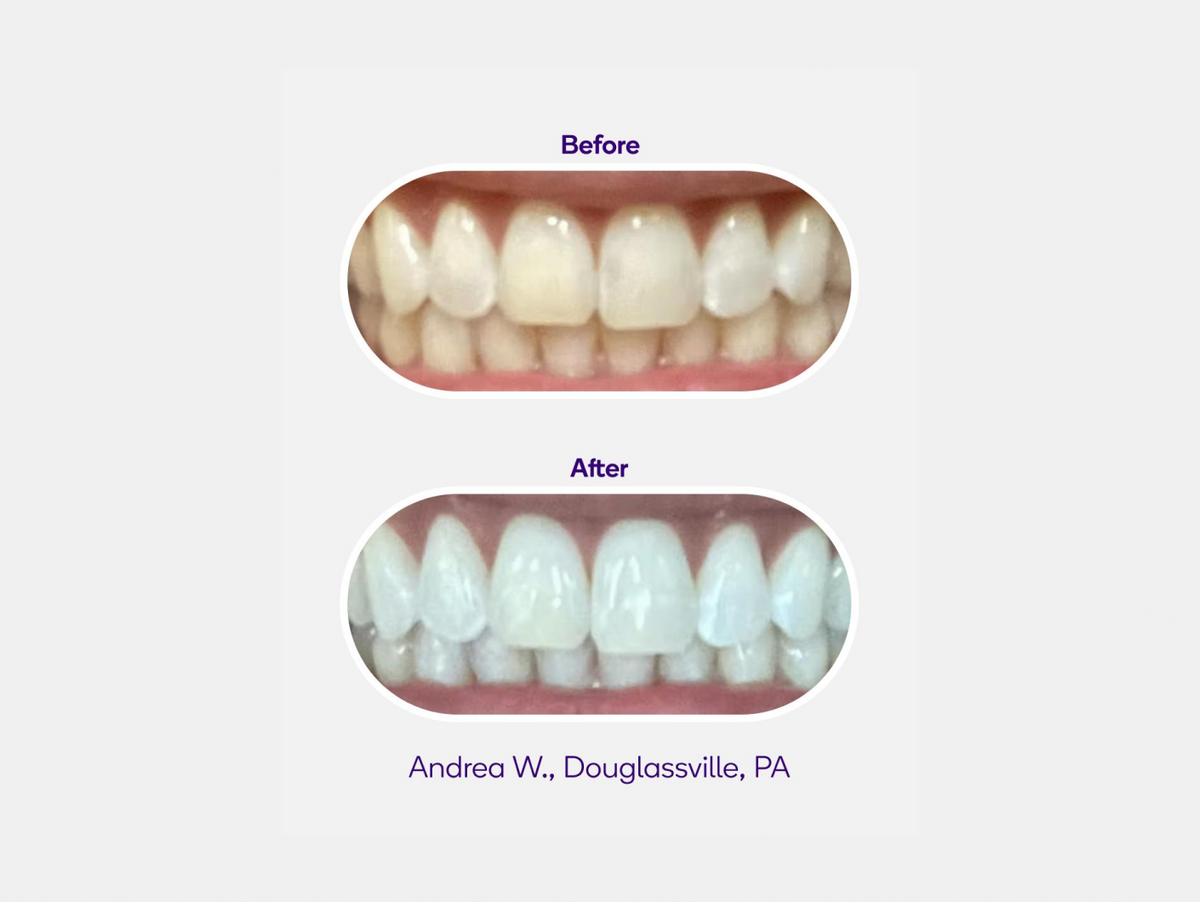 Whitening Strips
