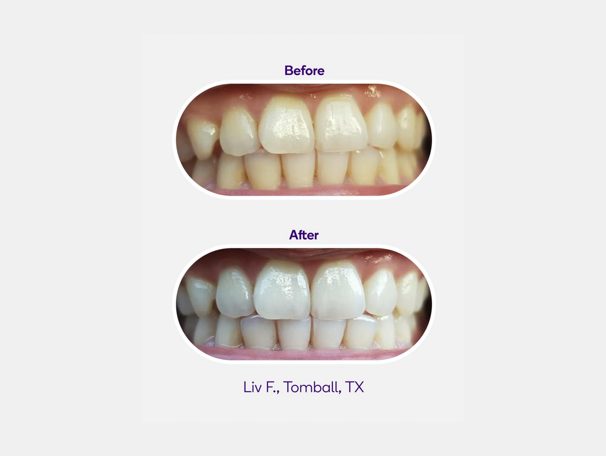 Whitening Strips