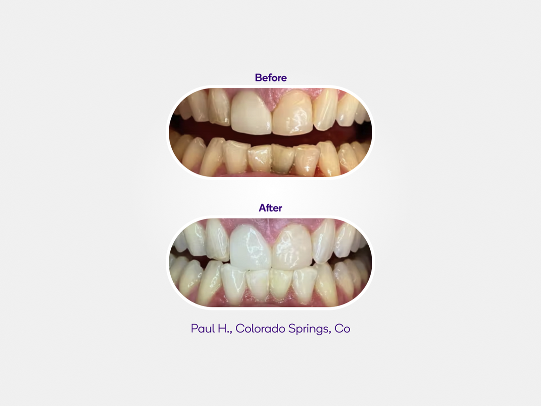 Prefilled Whitening Trays BURST Oral Care