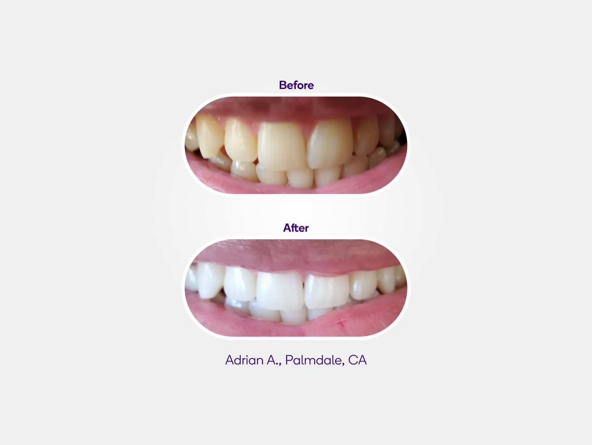 Prefilled Whitening Trays 3 pack Refill